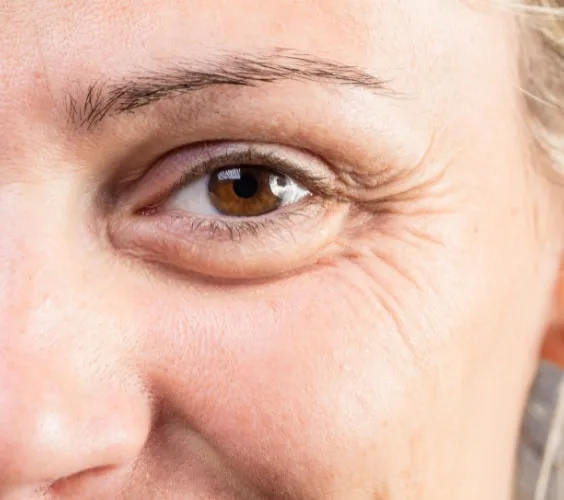 Crows Feet