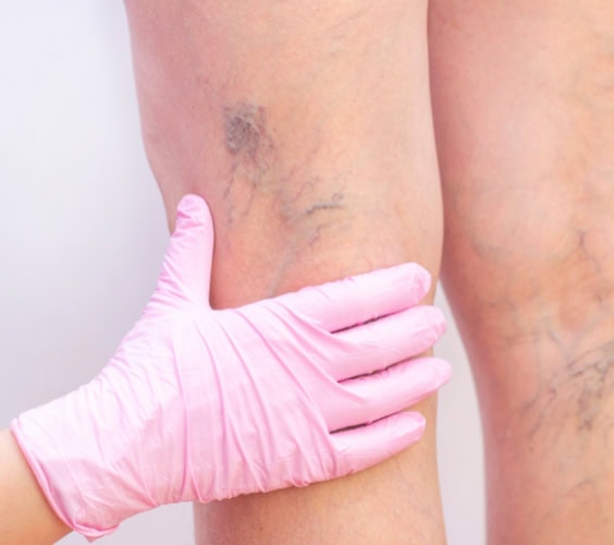 Female legs with varicose Female legs with varicose