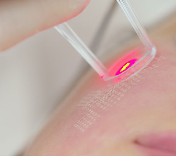 Fotona Laser Skin Resurfacing Fotona Laser Skin Resurfacing