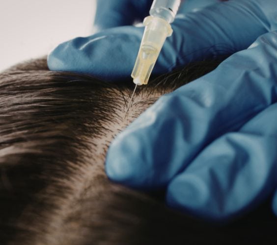 Hair Restoration (Laser & PRP) Hair Restoration Laser PRP