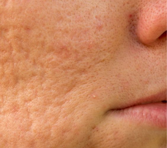 Subcision for Scarring Subcision for Scarring