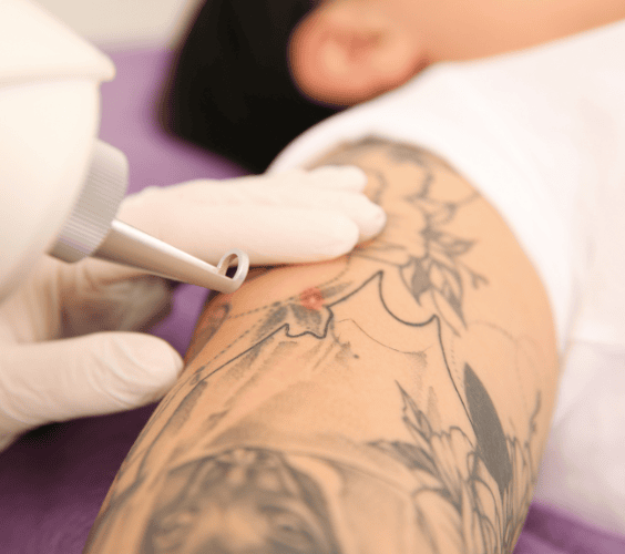 Unwanted Hair & Tattoos Unwanted Hair Tattoos
