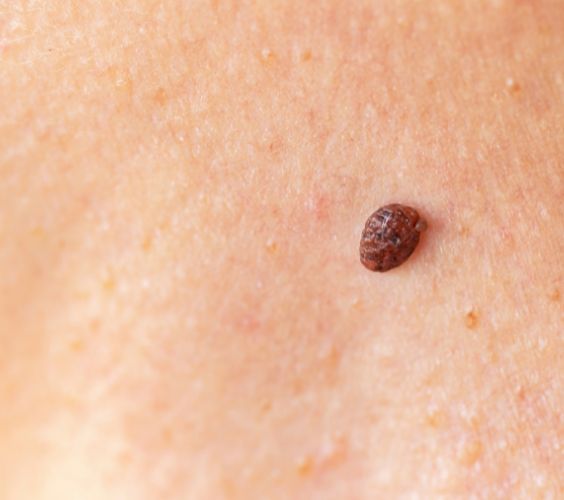benign lesion benign lesion